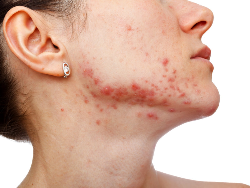Acne Prone