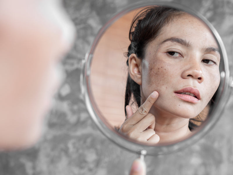 Hyperpigmentation