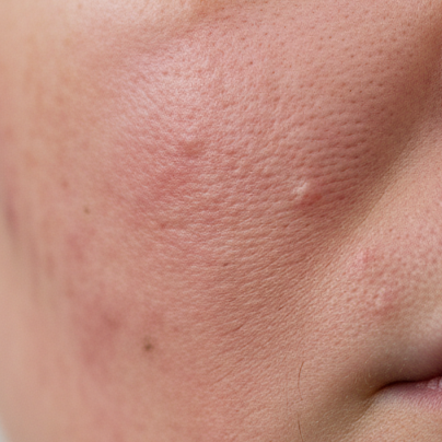 breakout skin