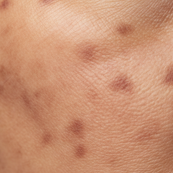 photorealistic hyperpigmentation