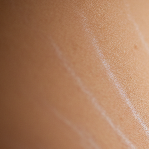 stretch mark